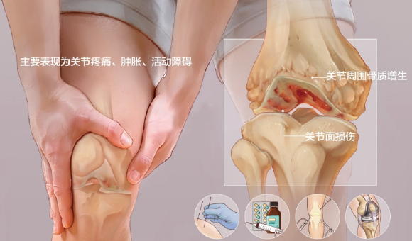 牙髓干細胞外泌體—骨關節炎